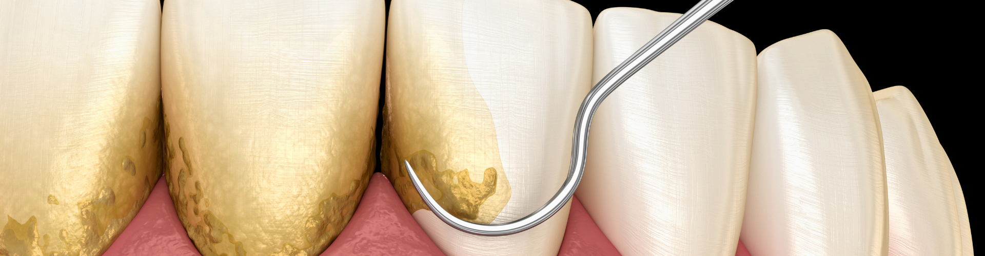 Rendering of dental scraper removing buildup from teeth.